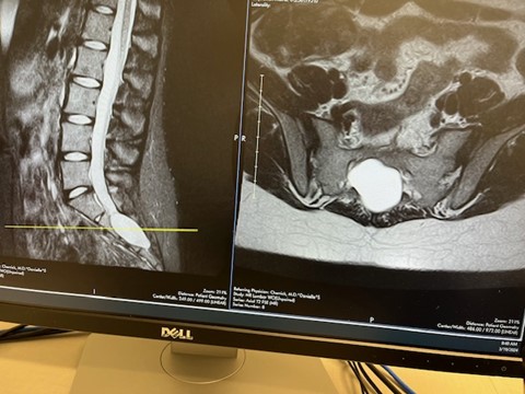 Unmasking the Cause: A Journey Through Pelvic Pain to a Rare&nbsp;Diagnosis